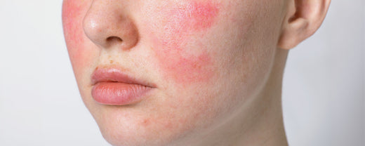 Close-up of a face with visible facial redness and red spots, illustrating the impact of skin conditions like rosacea, acne, and allergic reactions, and the importance of proper skincare for reducing facial redness.