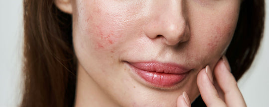 Close-up image of a woman's face showing visible acne, with detail on the texture and redness of the skin, highlighting the impact of skin conditions.
