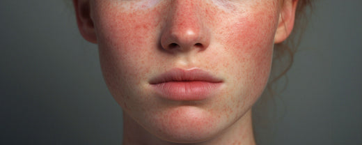 Close-up of a woman's face with visible redness and irritation, highlighting the challenges of sensitive skin care.