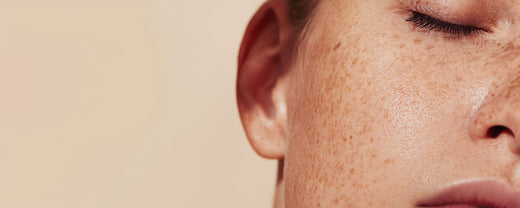Close-up of a woman’s face with visible freckles and smooth skin, highlighting clear skin after using a targeted skincare regimen.