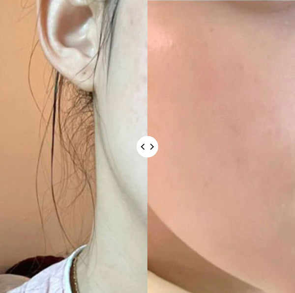  a before and after slider image of a woman’s skin