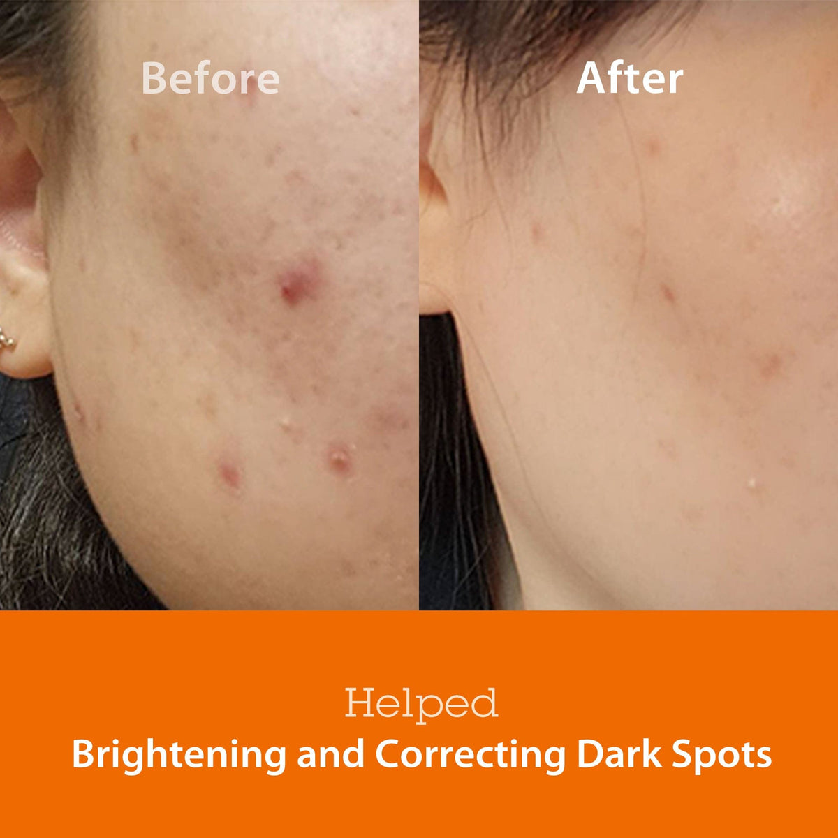 Before and after comparison showing the effectiveness of Blithe Targeted Blemish Serum with Niacinamide 5.0 in brightening and correcting dark spots