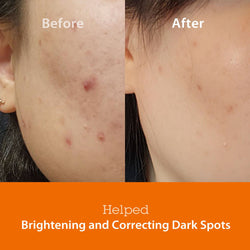 Before and after comparison showing the effectiveness of Blithe Targeted Blemish Serum with Niacinamide 5.0 in brightening and correcting dark spots