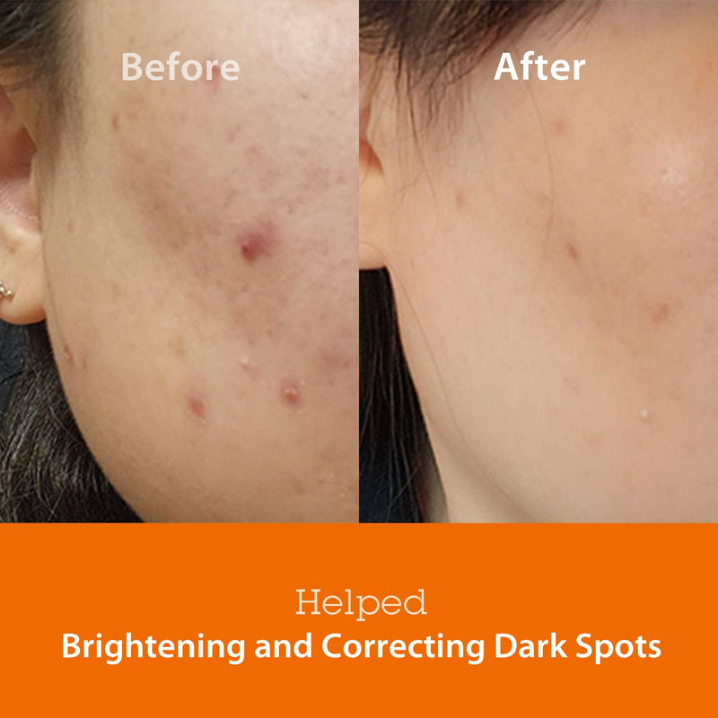 Before and after comparison showing the effectiveness of Blithe Targeted Blemish Serum with Niacinamide 5.0 in brightening and correcting dark spots