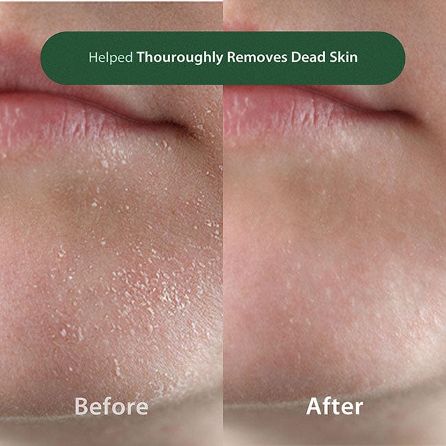 Blithe Pore Cleansing BHA Best Pore Cleanser For Blackhead Removal blithe-pore-cleansing-bha-best-pore-cleanser-for-blackhead-removal
